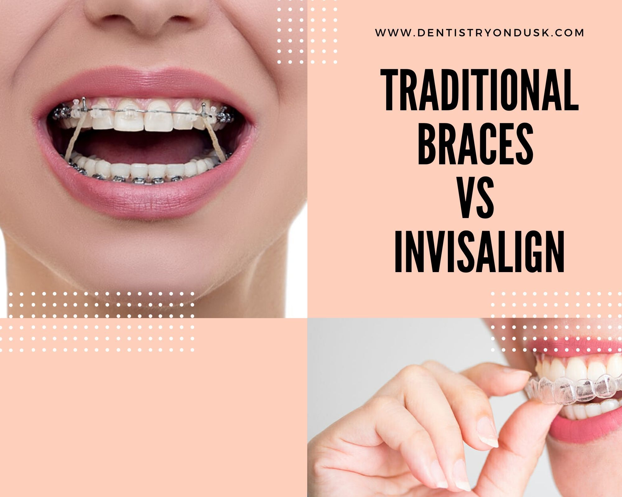 affordable Invisalign